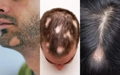 Зуд кожи головы — 7 возможных причин — что делать при зуде кожи головы и  выпадении волос