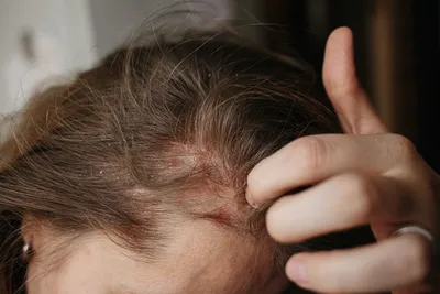 Лечение болячек и ранок на коже головы — Причины появления корок в волосах  - Клиника «Доктор Волос»