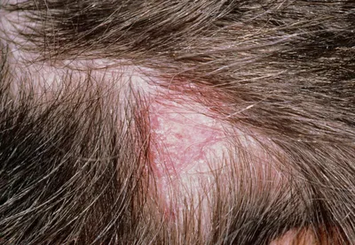 Причины заболевания волос и кожи головы | Медицинский центр Эра