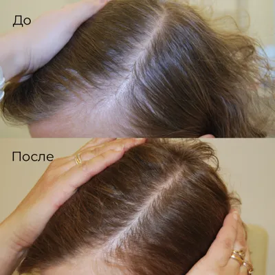 Диагностика волос Харьков - Центр европейской дерматологии
