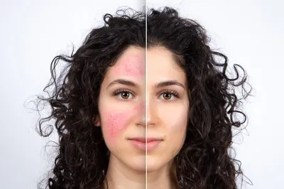 Почему краснеет кожа лица: 8 неочевидных причин - Новости здоровья -  Здоровье 24