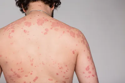 Заболевания кожи лица: виды, причины, лечение | Prima Derm