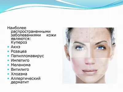 Важно знать о розацеа | Tori Clinic | Дзен