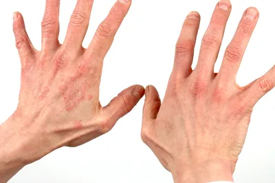 Заболевания кожи на руках фото фото