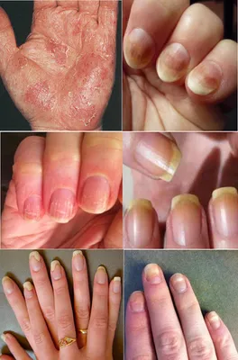 Заболевания кожи рук и ногтей фото фото