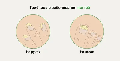 Болезни ногтей: виды, симптомы, лечения и профилактика - FitoBlog