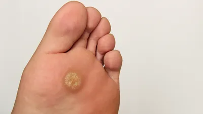 Лечение грибковых инфекций кожи и ногтей: противогрибковые препараты  широкого спектра действия