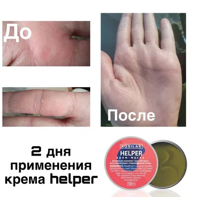Лечение гиперкератоза стоп в Киеве - Центр подологии NeoVita