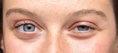 Остерегаться!Как только появятся глаза, эти 8 симптомов могут быть  признаками серьезного заболевания.