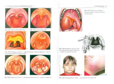 Грибковые заболевания полости рта | Remedium.ru