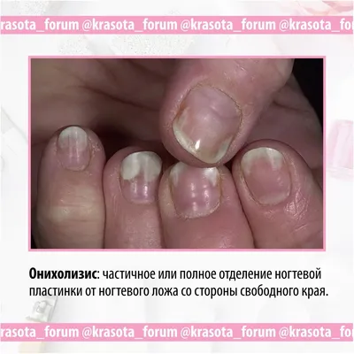 Болезни ногтей: симптомы, причины и методы лечения | Ногти.ру