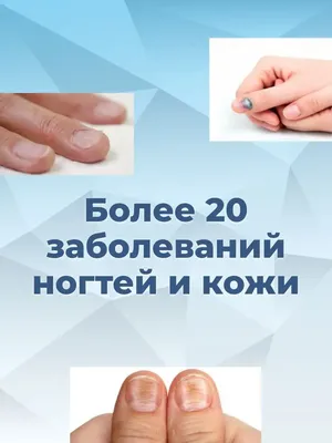 Заболевания ногтей. Онихолизис. Онихорексис. Онихошизис. | Блог Хорошего  Мастера | Дзен