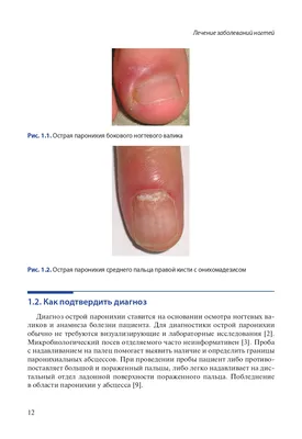 Диагностика и лечение заболеваний ногтей - Ева Арт
