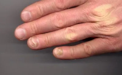 Трахионихия («песчаные» ногти) – симптомы, причины, лечение и профилактика  заболевания