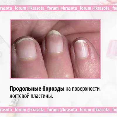 Врач рассказал, как по ногтям определить заболевания — Ferra.ru