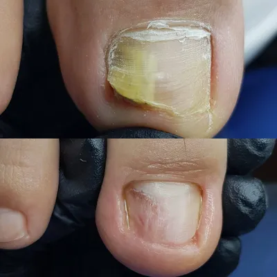 Ониходистрофия у детей: причины, лечение ониходистрофии ногтей у ребенка ✓  Клиника подологии Полёт в Москве