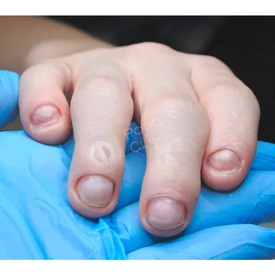 Методы лечения онихокриптоза (вросшего ногтя) у детей ✓ Авторские статьи  Клиники Подологии