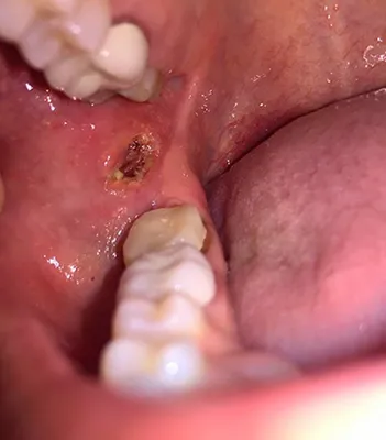 Профилактика онкологических заболеваний слизистой оболочки полости рта |  14-я городская стоматологическая поликлиника