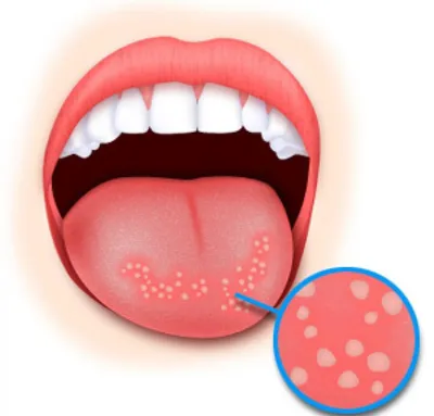 Классификация заболеваний слизистой оболочки полости рта
