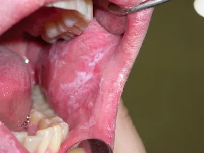 Заболевания слизистой оболочки полости рта у детей