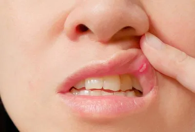 Грибковые заболевания полости рта – тема научной статьи по ветеринарным  наукам читайте бесплатно текст научно-исследовательской работы в  электронной библиотеке КиберЛенинка
