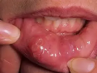 Профилактика заболеваний слизистой полости рта у детей - УЗ «Гродненская  университетская клиника»
