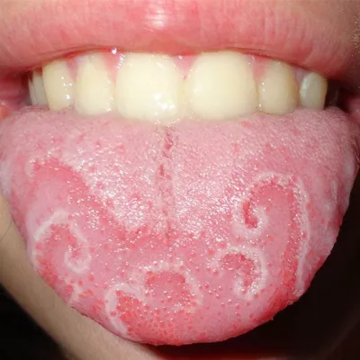 Стоматологический гель для лечения повреждений полости рта