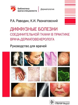 Системная красная волчанка, дерматомиозит и другие болезни соединительной  ткани - Доктор Позвонков