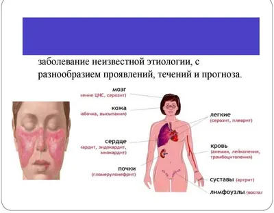 Трудности дифференциальной диагностики системных заболеваний соединительной  ткани и онкологических заболеваний – тема научной статьи по клинической  медицине читайте бесплатно текст научно-исследовательской работы в  электронной библиотеке КиберЛенинка