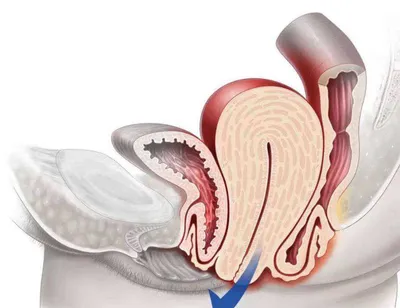Опущение стенок влагалища – причины, симптомы и лечение