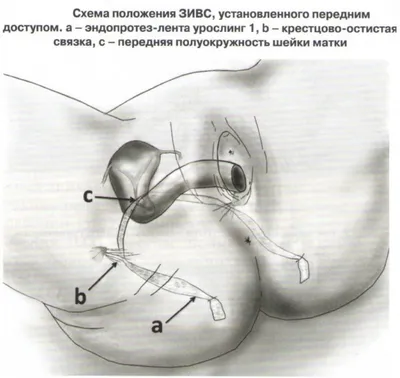 Пластика влагалища (вагинопластика) - цена, операция по пластике передней и  задней стенок влагалища в Москве