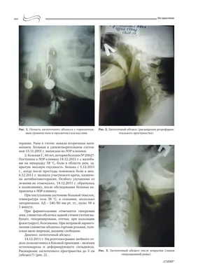 Заглоточный абсцесс - Заболевания ушей, носа и горла - Справочник MSD  Версия для потребителей