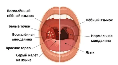 Абсцесс: паратонзиллярный, или горла, заглоточный, легкого, печени