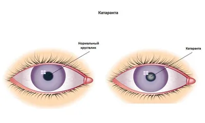 Лечение катаракты -Услуги
