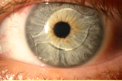 Замена хрусталика глаза. Операция по замене хрусталика глаза в клинике им.  Федорова