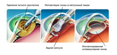 Как заменяют хрусталик при катаракте | Факоэмульсификация в клинике World  Vision