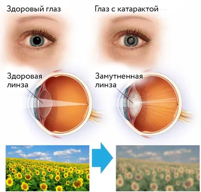 Удалили катаракту: рекомендации и возможные осложнения