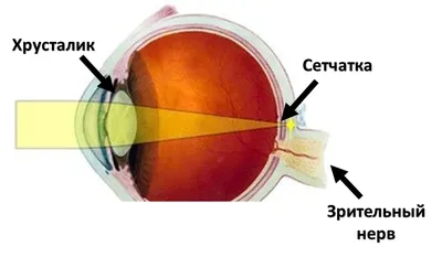 Замена хрусталика глаза: новости офтальмологии в лечении катаракты - YouTube