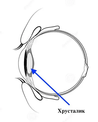 Катаракта и замена хрусталика глаза: ответы на ваши вопросы #2 - YouTube