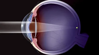 Замена хрусталика при катаракте глаза: какой выбрать при операции | Клиника\" ГЛАЗ\" имени С.Н.Федорова | Дзен
