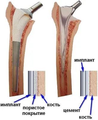 Реабилитации после эндопротезирования суставов в Крыму на основе  кинезитерапии