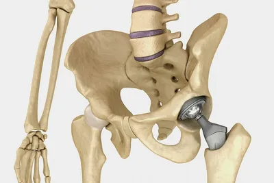 Ревизионное эндопротезирование тазобедренного сустава