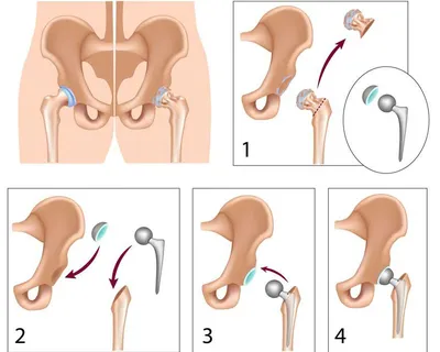 Ревизионное эндопротезирование тазобедренного сустава