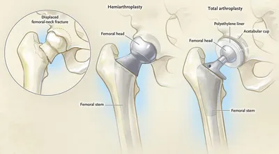 Эндопротезирование тазобедренного сустава. Когда это необходимо? |  Здоровье, долголетие, молодость | Дзен