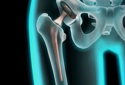 Эндопротезирование тазобедренного сустава — стоимость операции на тазобедренном  суставе │ Центр травматологии и ортопедии ГУТА КЛИНИК
