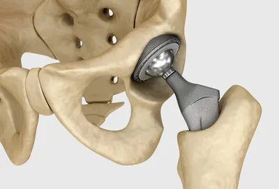 Замена тазобедренного сустава в Израиле | Клиника Хадасса