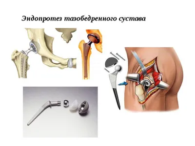 Эндопротезирование тазобедренного сустава в Москве