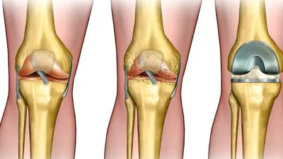 Почему вывихивается протез тазобедренного сустава?