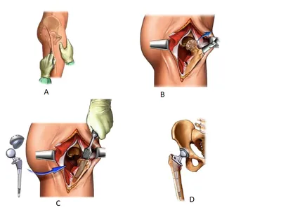 Замена тазобедренного, коленного сустава операция в Белоруссии