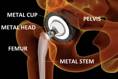 Замена тазобедренного сустава у женщины 77 лет